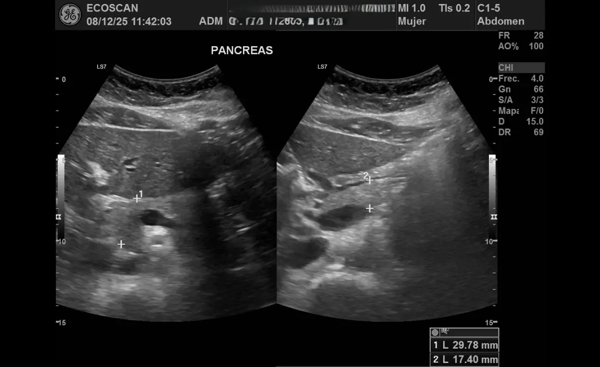 Ultrasonido abdominal en EcoScan León