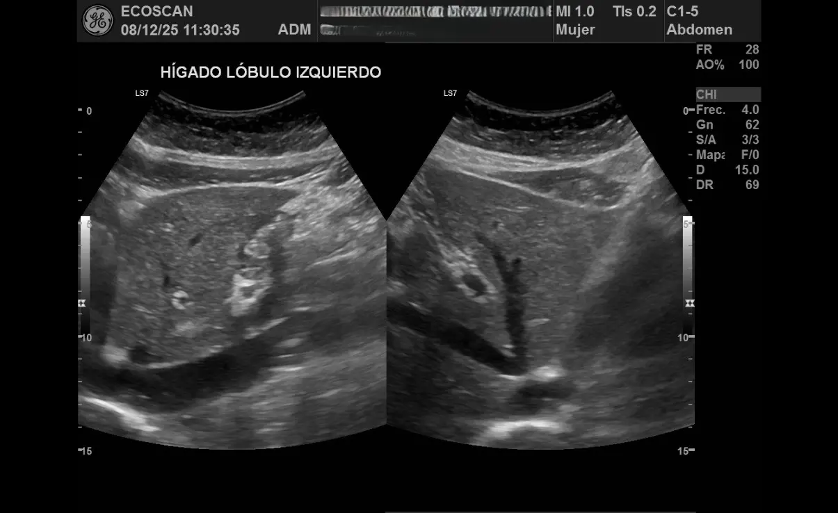 Ultrasonido abdominal en EcoScan León