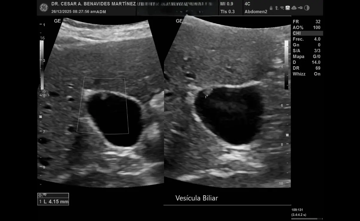 Ultrasonido abdominal en EcoScan León