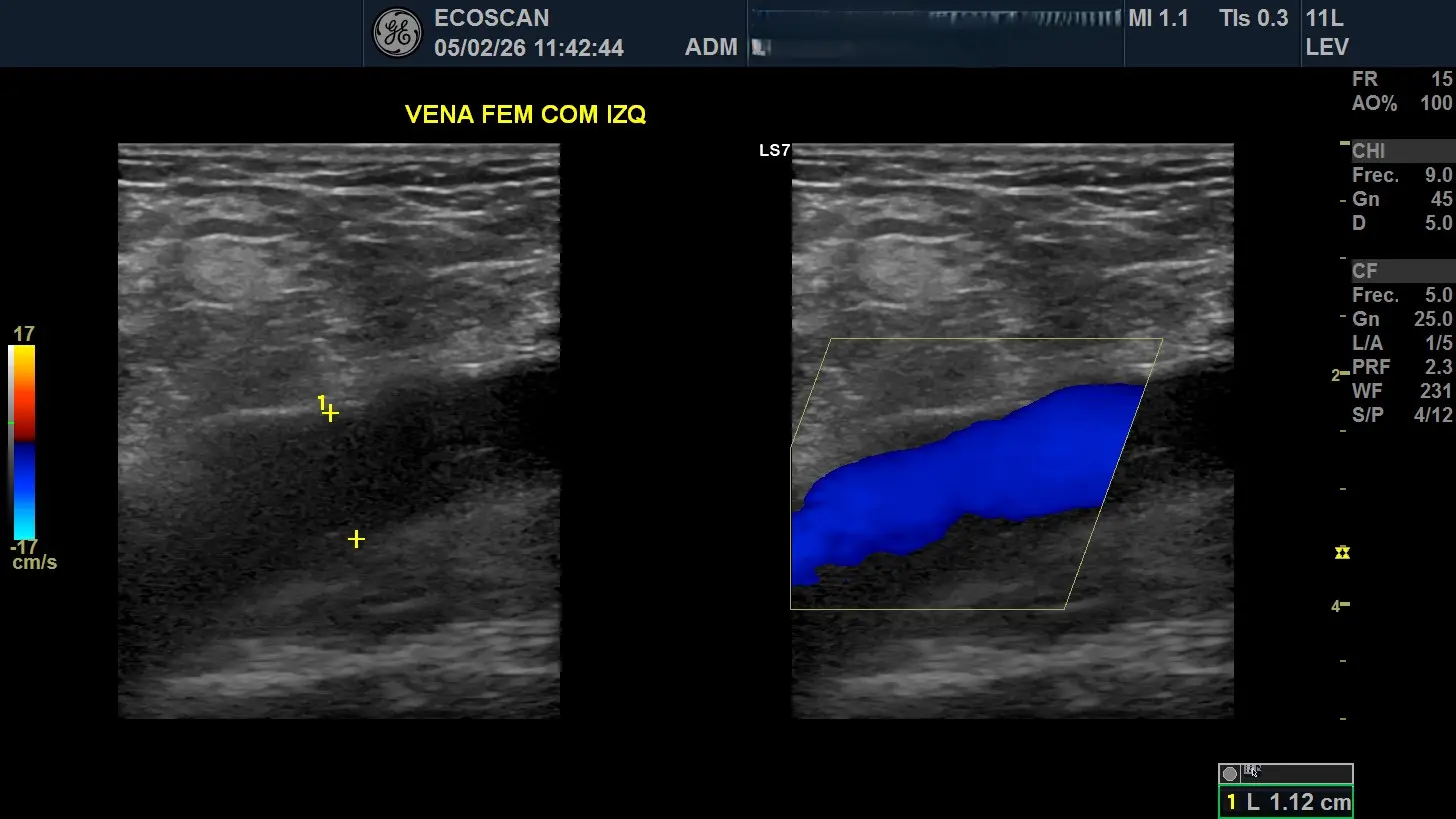 Ultrasonido Doppler en EcoScan León