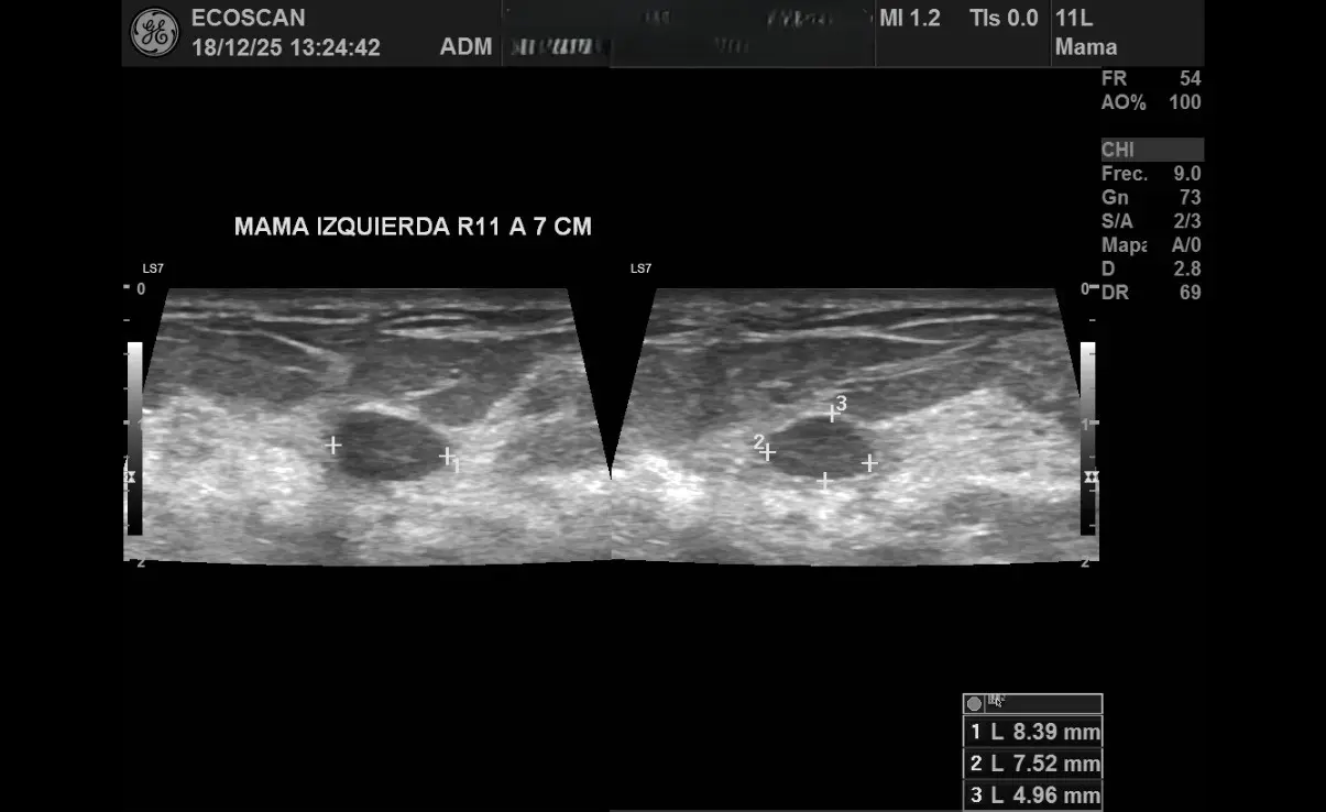 Ultrasonido mamario en EcoScan León