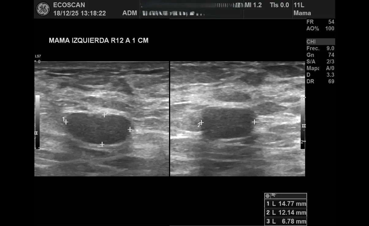 Ultrasonido mamario en EcoScan León