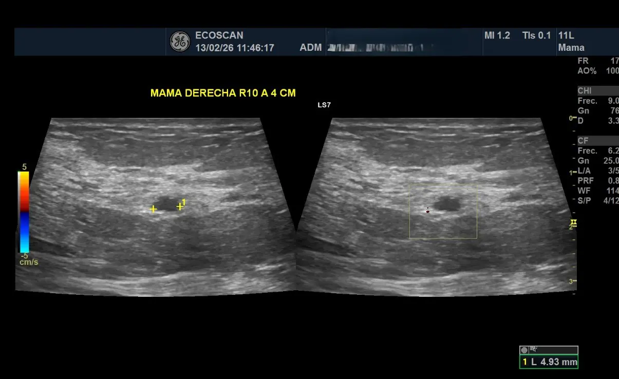 Ultrasonido mamario en EcoScan León