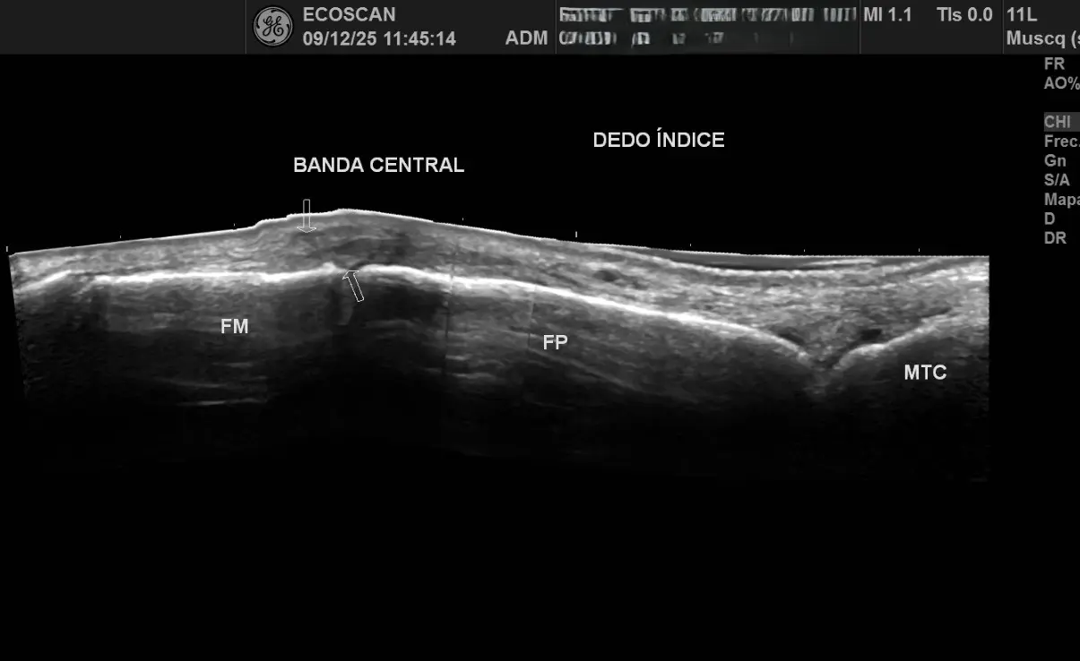 Ultrasonido musculoesquelético en EcoScan León