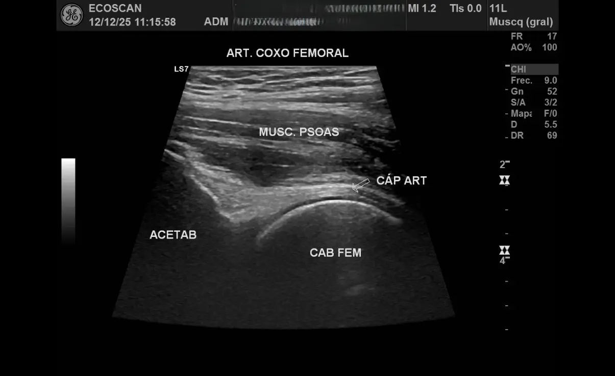 Ultrasonido musculoesquelético en EcoScan León