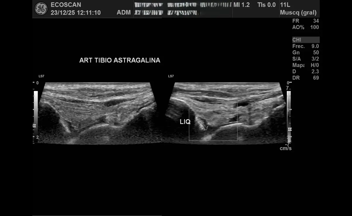 Ultrasonido musculoesquelético en EcoScan León