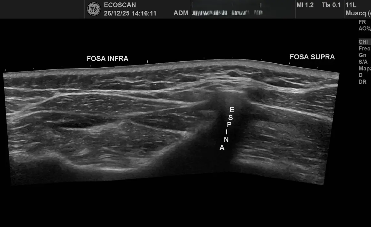 Ultrasonido musculoesquelético en EcoScan León