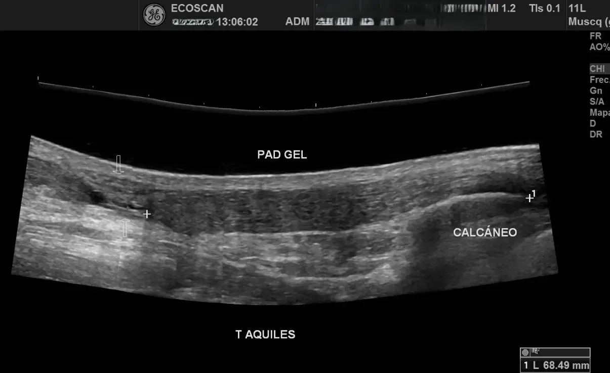 Ultrasonido musculoesquelético en EcoScan León