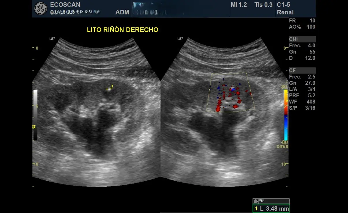 Ultrasonido renal en EcoScan León