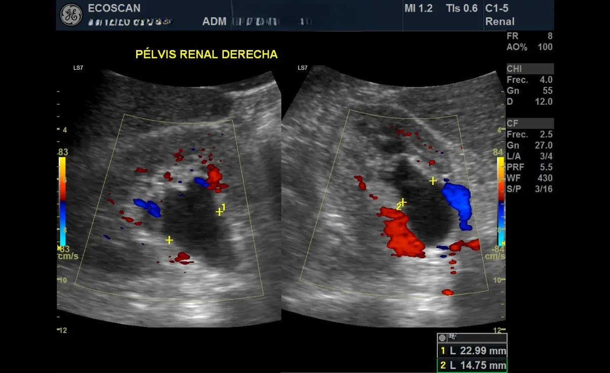 Ultrasonido renal en EcoScan León