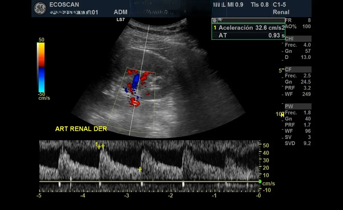 Ultrasonido renal en EcoScan León