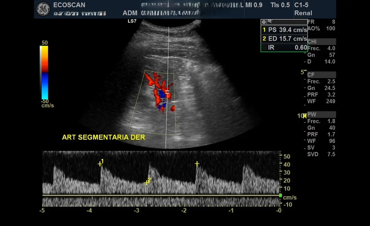 Ultrasonido renal en EcoScan León