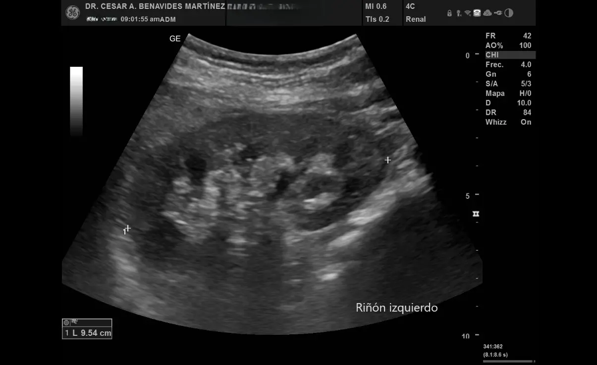 Ultrasonido renal en EcoScan León