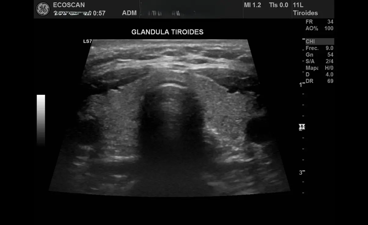 Ultrasonido tiroideo en EcoScan León
